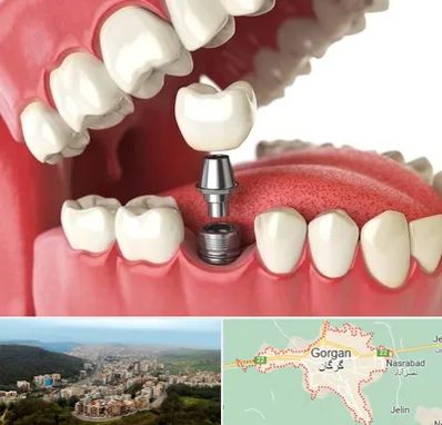 متخصص پروتز دندان در گرگان