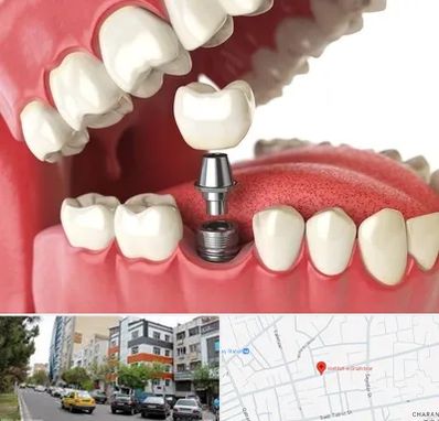 متخصص پروتز دندان در هفده شهریور تبریز