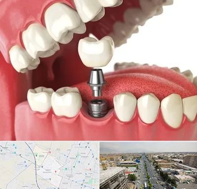 متخصص پروتز دندان در حصارک کرج