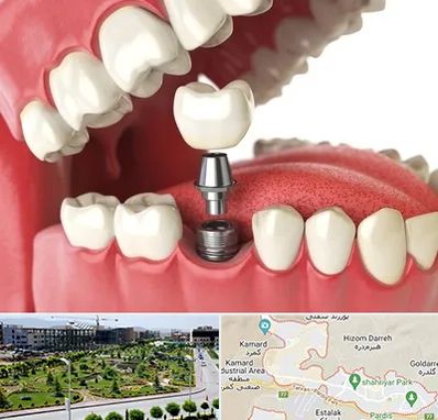 متخصص پروتز دندان در پردیس