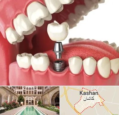 متخصص پروتز دندان در کاشان