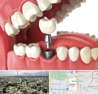 متخصص پروتز دندان در گیشا