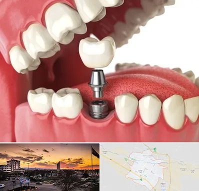 متخصص پروتز دندان در قوچان