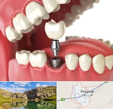 متخصص پروتز دندان در فیروزکوه