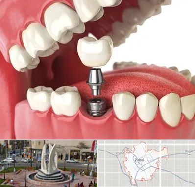 متخصص پروتز دندان در زابل