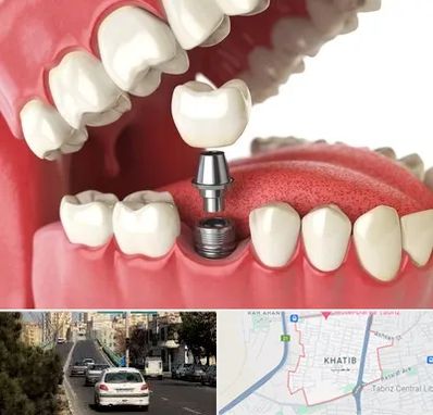 متخصص پروتز دندان در خطیب تبریز