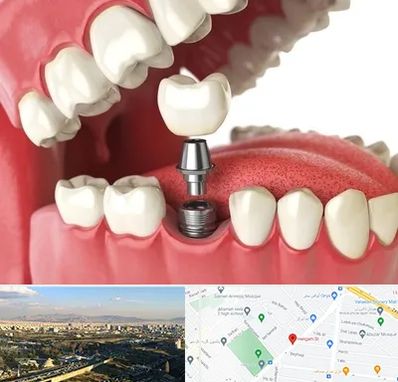 متخصص پروتز دندان در هنگام