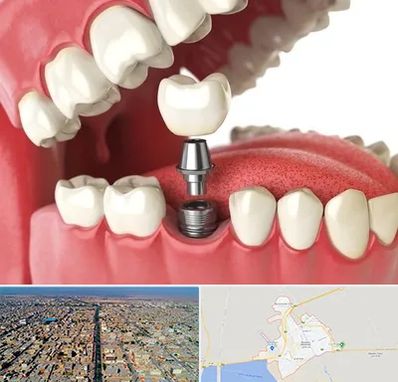 متخصص پروتز دندان در بندر ماهشهر
