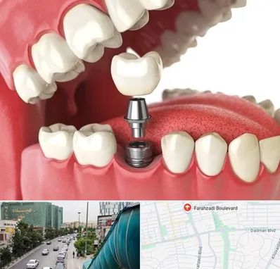متخصص پروتز دندان در بلوار فرحزادی