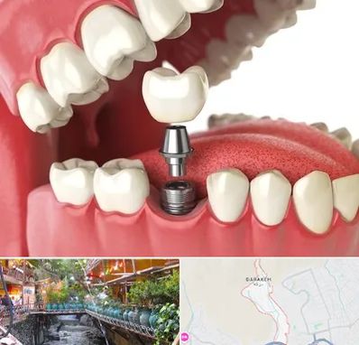 متخصص پروتز دندان در درکه