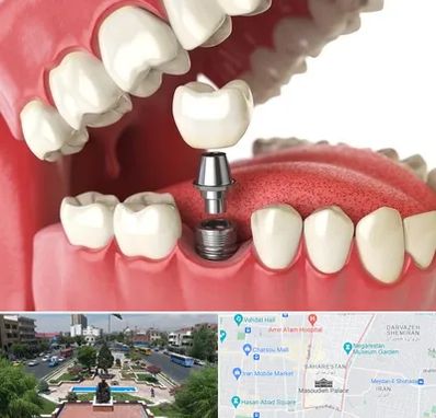 متخصص پروتز دندان در بهارستان