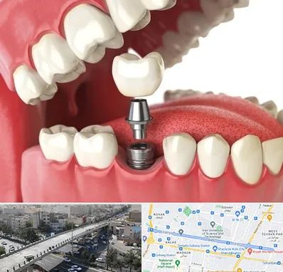 متخصص پروتز دندان در فرجام