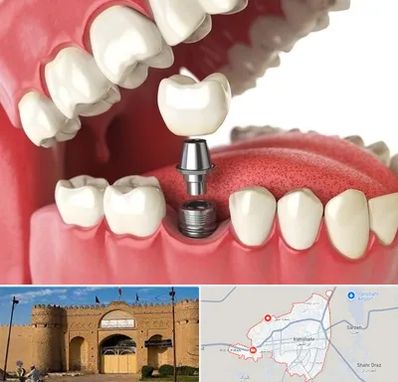 متخصص پروتز دندان در ایرانشهر