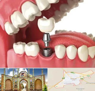متخصص پروتز دندان در سمنان