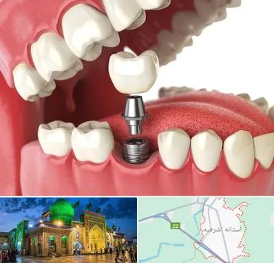 متخصص پروتز دندان در آستانه اشرفیه