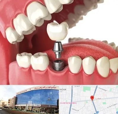 متخصص پروتز دندان در نصف راه تبریز