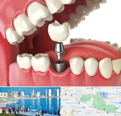 متخصص پروتز دندان در چیتگر