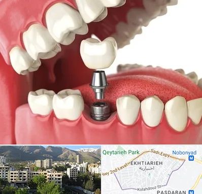 متخصص پروتز دندان در اختیاریه