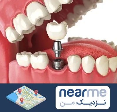 متخصص پروتز دندان در نزدیک من