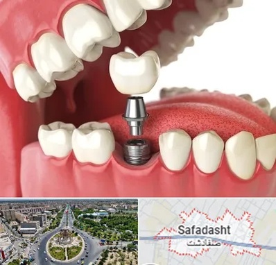 متخصص پروتز دندان در صفادشت