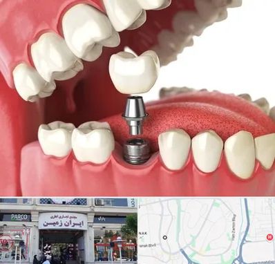 متخصص پروتز دندان در ایران زمین
