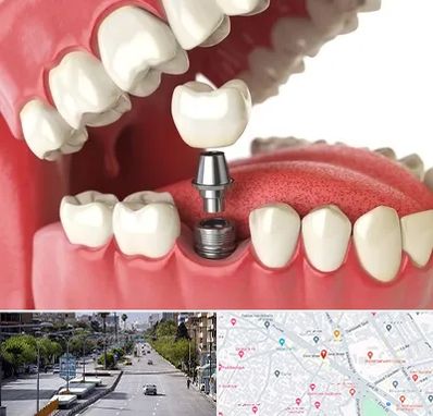 متخصص پروتز دندان در خیابان زند شیراز