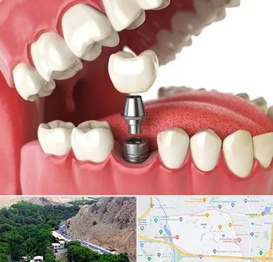 متخصص پروتز دندان در کن