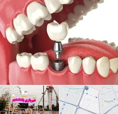 متخصص پروتز دندان در پادادشهر اهواز