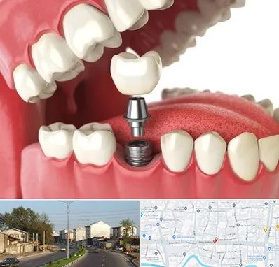 متخصص پروتز دندان در ضیابری رشت