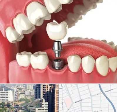 متخصص پروتز دندان در خیابان بهشتی