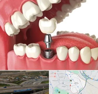 متخصص پروتز دندان در یاغچیان تبریز