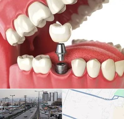 متخصص پروتز دندان در بلوار ارتش