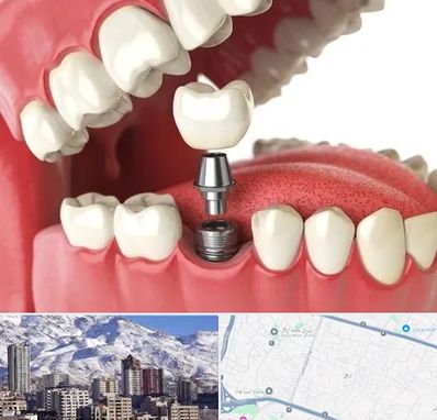 متخصص پروتز دندان در ازگل