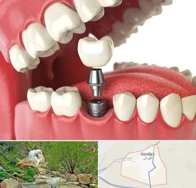 متخصص پروتز دندان در کردان