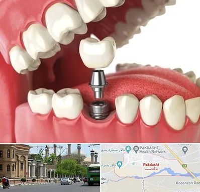 متخصص پروتز دندان در پاکدشت