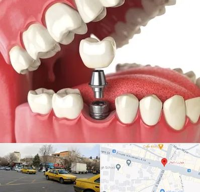 متخصص پروتز دندان در شهناز تبریز