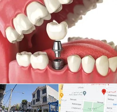 متخصص پروتز دندان در افسریه