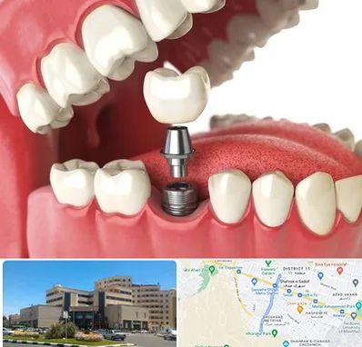 متخصص پروتز دندان در صیاد شیرازی مشهد