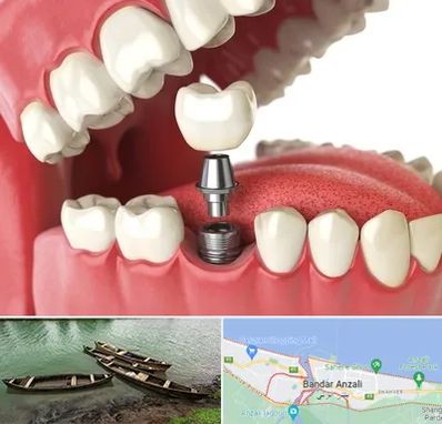 متخصص پروتز دندان در بندر انزلی