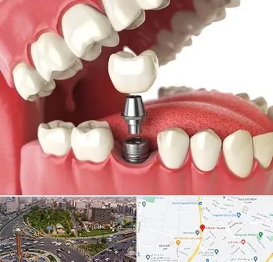 متخصص پروتز دندان در سبلان