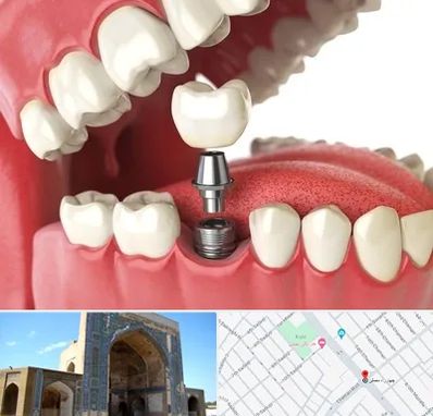 متخصص پروتز دندان در مصلی مشهد