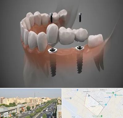 ایمپلنت دیجیتال در کیانمهر کرج