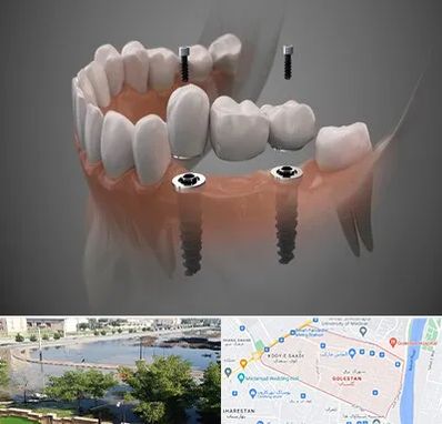 ایمپلنت دیجیتال در گلستان اهواز
