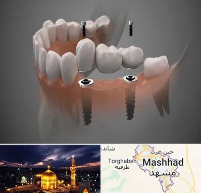 ایمپلنت دیجیتال در مشهد