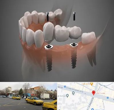 ایمپلنت دیجیتال در شهناز تبریز
