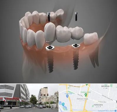 ایمپلنت دیجیتال در بلوار فردوس 