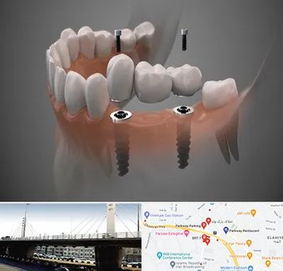 ایمپلنت دیجیتال در پارک وی 