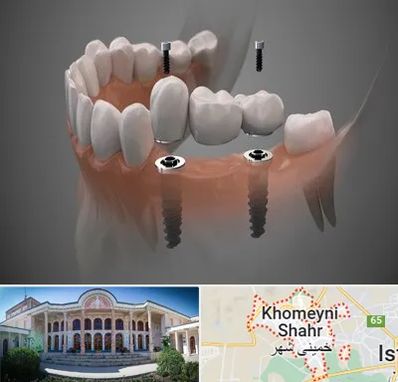 ایمپلنت دیجیتال در خمینی شهر