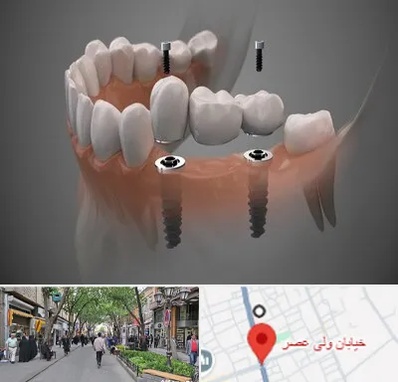 ایمپلنت دیجیتال در ولیعصر شهریار
