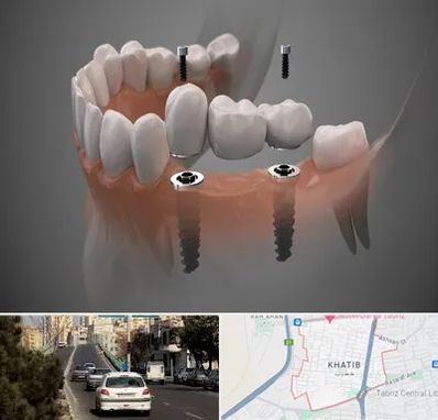 ایمپلنت دیجیتال در خطیب تبریز